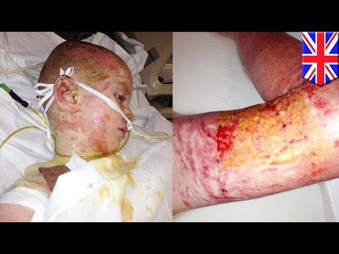 Rare skin disease infects little boy and he loses almost all his skin, nearly cost him his life