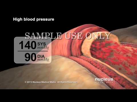 High Blood Pressure