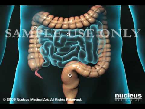 Appendicitis Surgery: Laparoscopic Appendectomy