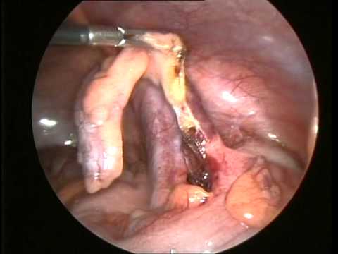 Appendix Operation