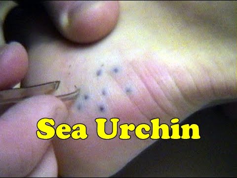 Sea Urchin Sting Removal Maui Hawaii | Daredevil Girl