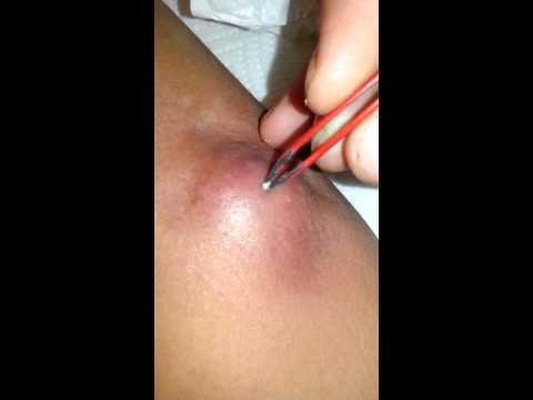 Popping huge sebaceous cyst