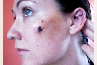 Kara Burns uses 'medical selfies' to check her wounds are healing - 