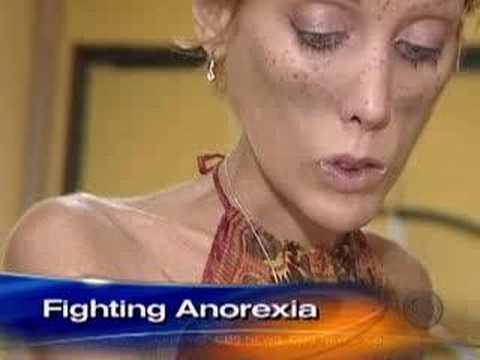 Anorexia's Childhood Roots (CBS News)