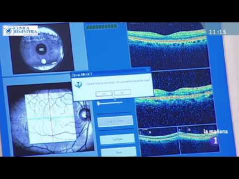 Prueba de OCT Macular y Nervio Óptico