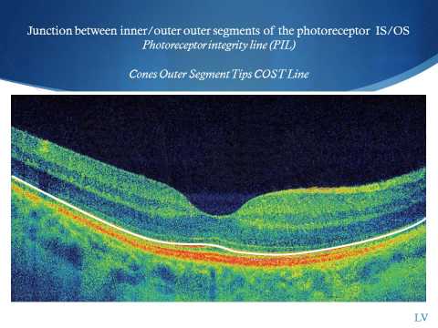 OCT Macula Lecture part 1