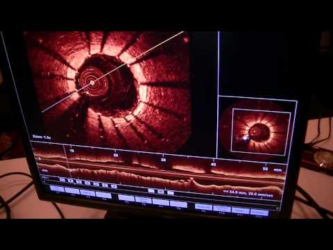 Cardiovascular Optical Coherence Tomography (OCT) explained