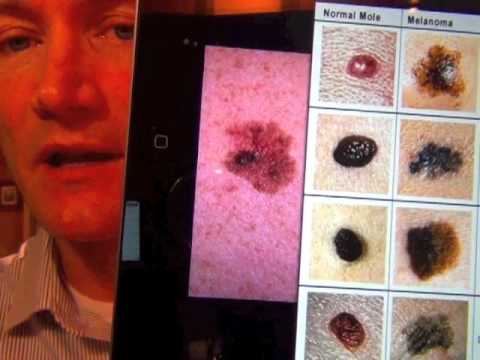 Mole vs Melanoma