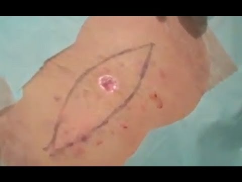 Melanoma Removal - GRAPHIC [DermTV Epi #467]