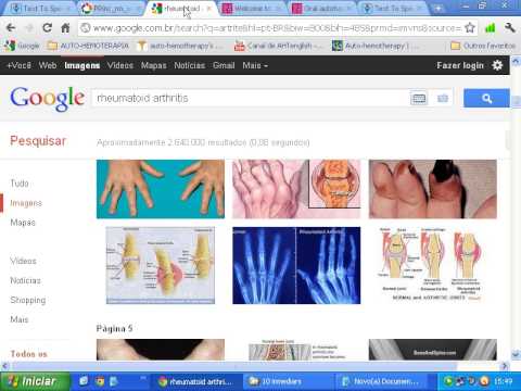 Oral autohaemotherapy in rheumatoid arthritis. [Extracted from IndMED]