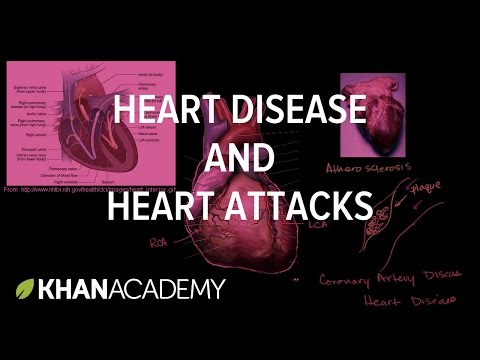 Heart Disease and Heart Attacks