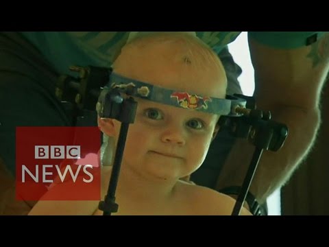 Toddler's head re-attached to spine - BBC News