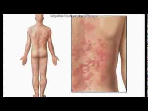 Natural Remedies For Hives Itchy Skin | Home Treatment For Hives Allergy In Children & Adults