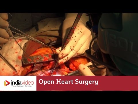 Open Heart Surgery