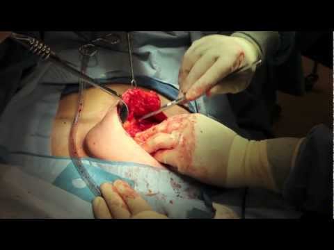 Live Surgery Skin Sparing Mastectomy with Immediate Allograft Tissue Expander Reconstruction.mov