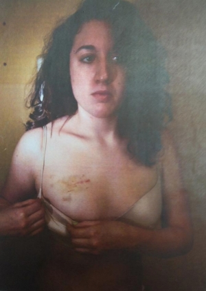 Cecily McMillan shows the hand-shaped bruise on her right breast, which she testified was made by NYPD Officer Grantley Bovell when he accosted her from behind.