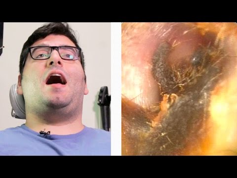 People Get Earwax Extractions For The First Time