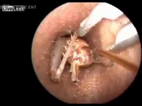 Tickly ear - Big Bug removed from a Ear!!