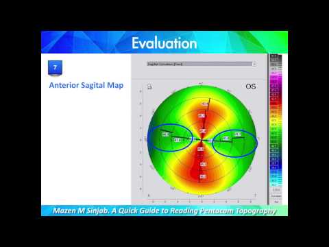 A Quick Guide to Reading Corneal Topography. Part 1