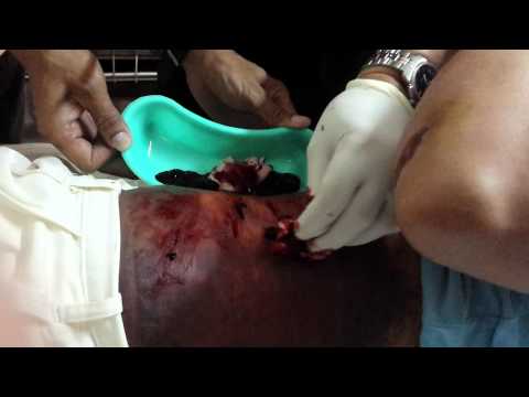 Hematoma Operation