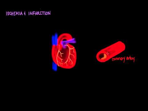 Ischemia and Infarction