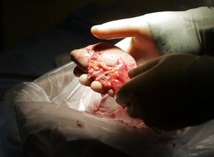 A surgeon holds a kidney removed from Laura Bolan Thursday, Feb. 21, 2008 at Emory University Hospital in Atlanta, jsa1