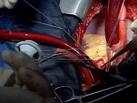 Denton Cooley Performs Mitral Valve Implantation