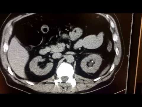 CT scan for kidney stone