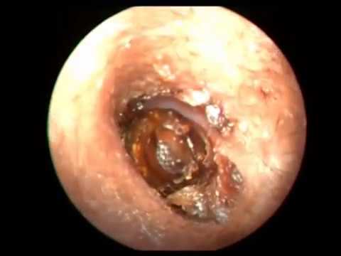 Ear Wax Removal THE BEST COMPILATION