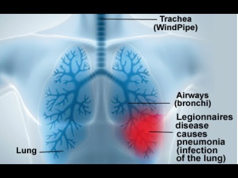 Legionnaires’ Disease Spikes In Flint Michigan!