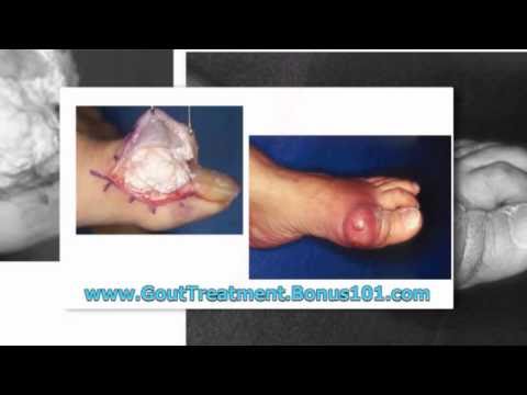 gout emedicine - gout treatment guidelines - gout treatments