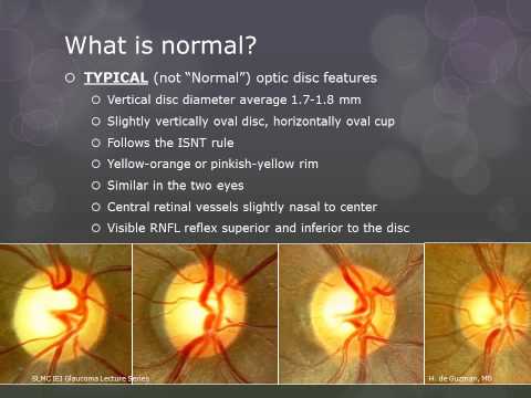 Optic Nerve Evaluation by Dr. Hannah de Guzman