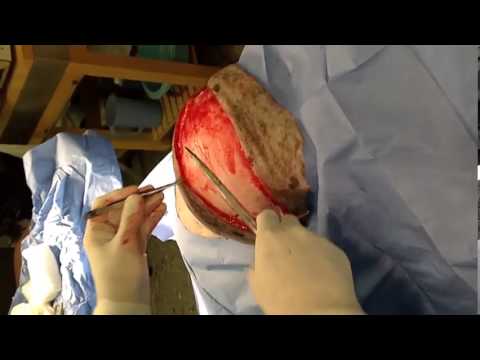 Veterinary Surgeon Removes Massive Lipoma (Fatty Tumor) from a Dog