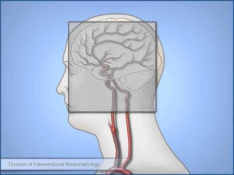 Diagnostic Cerebral Angiography