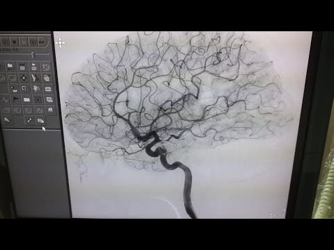 Cerebral Angiography