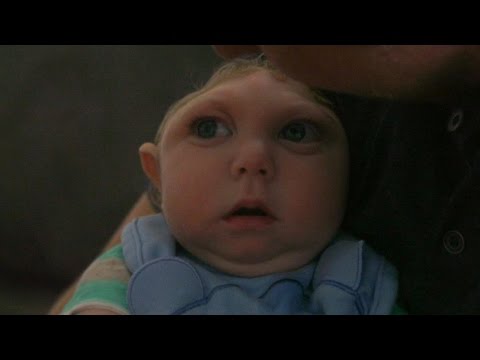 'Miracle Baby' Born Without Most of His Brain Defying Odds | ABC News