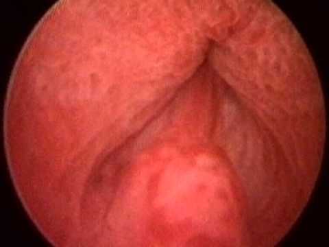 world premiere – male orgasm (ejaculation) filmed through an endoscope