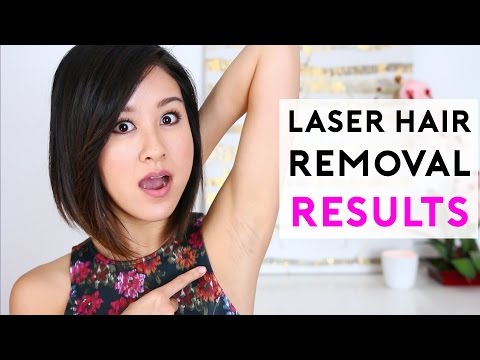 Laser Hair Removal RESULTS! | xteeener