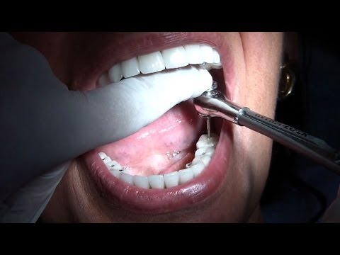 FULL MOUTH REHABILITATION WITH IMPLANT