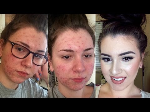 UPDATED | Acne Coverage Foundation Routine