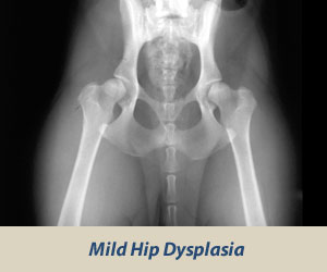 Mild Dysplasia