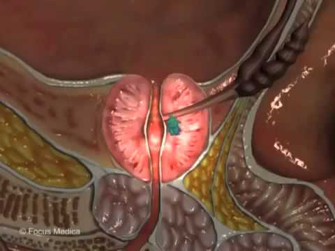 Prostate cancer, prostate cancer symptoms, prostate cancer treatment, prostate cancer in men