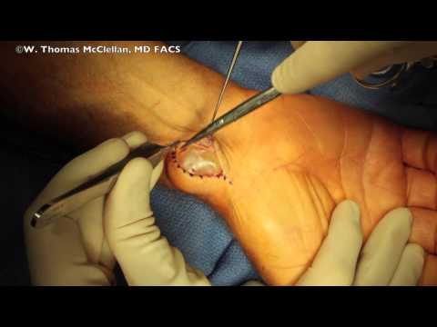 Live Surgery: Ganglion Cyst Volar Wrist