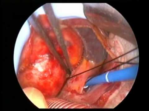 Heart Surgery: Minimally Invasive Aortic Valve Replacement