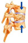 vertebra_fracture