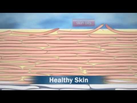 What is eczema?