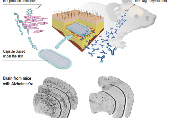 Cellular Implant Reduces Amyloid Beta Accumulation to Treat Alzheimer's