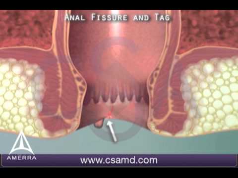 Anal Fissure - 3D Medical Animation