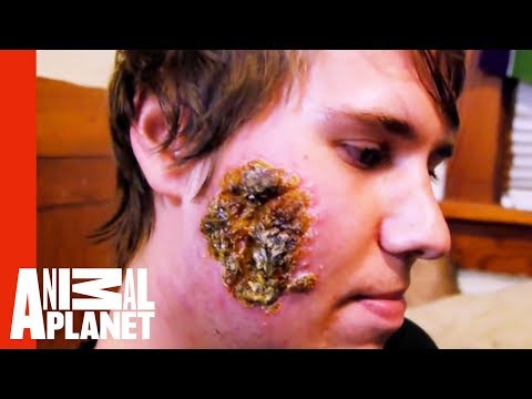 Leishmaniasis Creates Huge Open Wound on a Young Man's Face