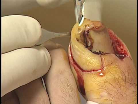 Vandenbos procedure for ingrown toenails